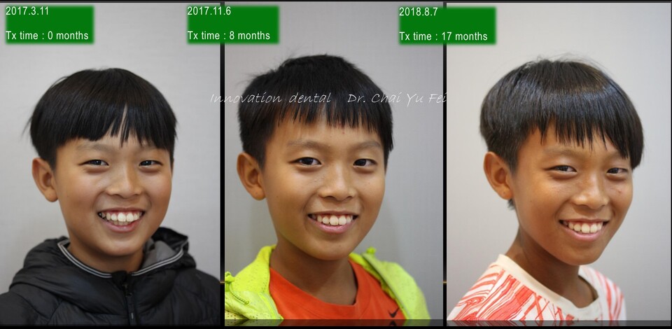 兒童口呼吸矯正患者