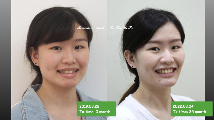 牙齒擁擠、臉型不立體怎麼辦？齒列擁擠矯正案例