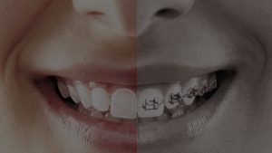 林口隱形矯正示意圖