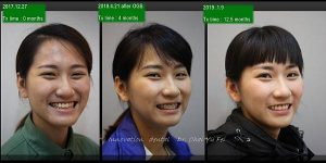 正顎手術解決下巴太長困擾