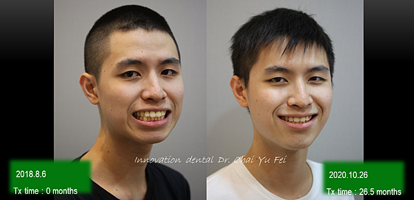 利用拔牙改善嘴唇前突、牙齦外露案例