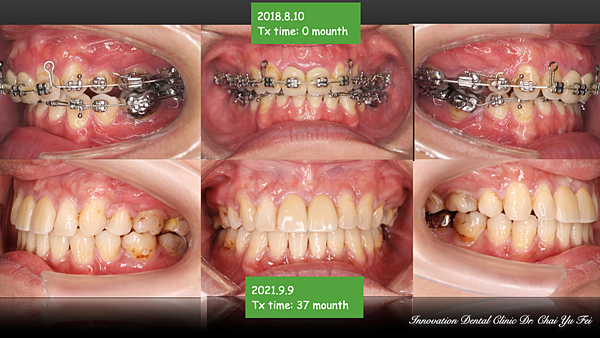 他院治療接手案例