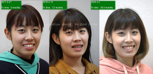 成人矯正外貌改善案例