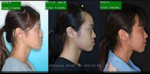 正顎手術成功且恢復期短