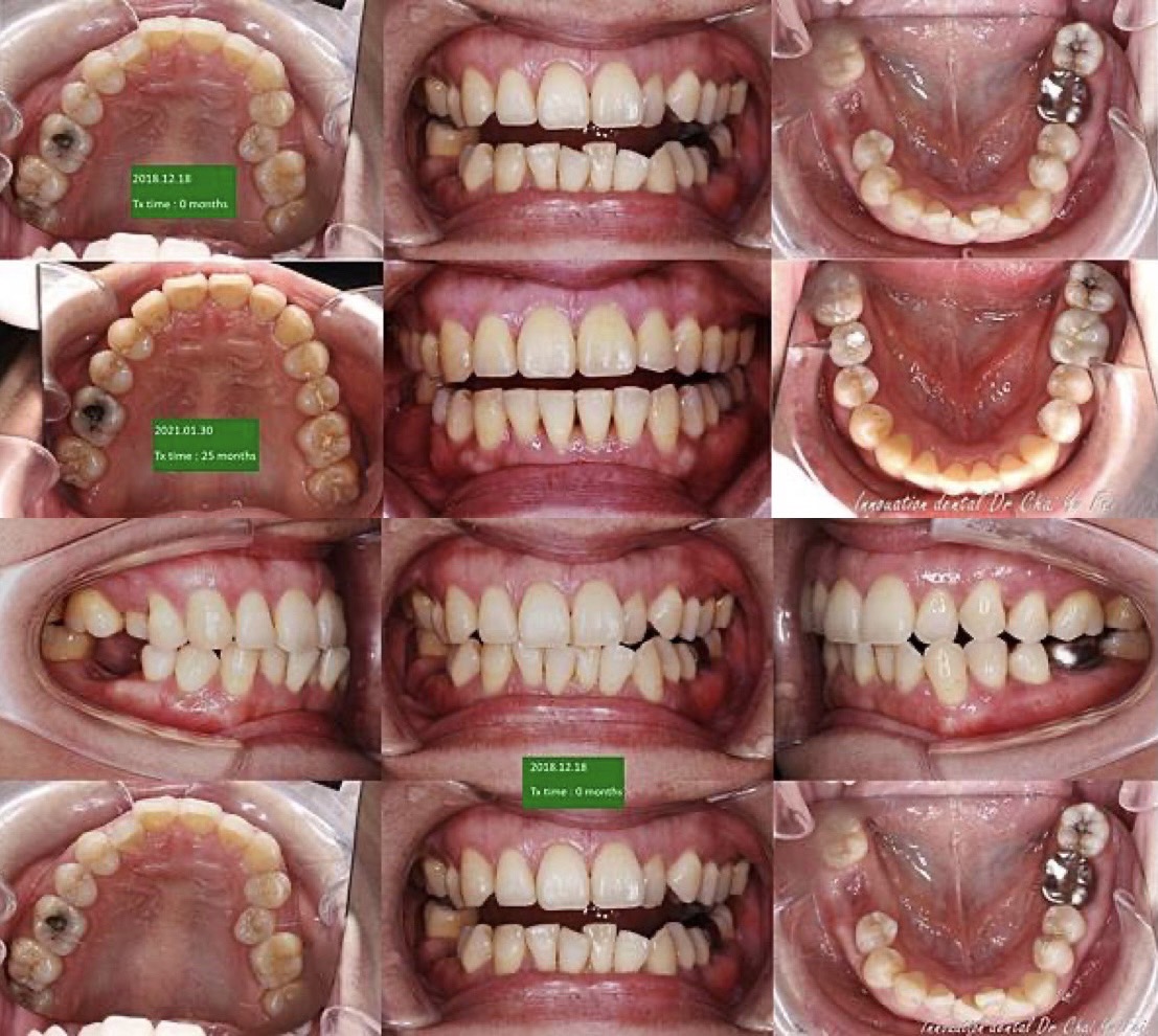 透過植牙穩定咬合之矯正案例