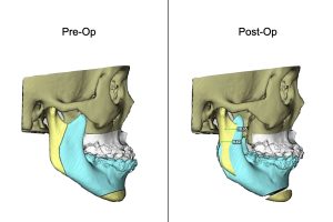 矯正合併正顎手術改變外觀案例