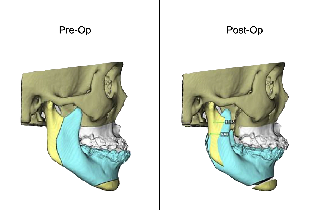 矯正合併正顎手術改變外觀案例