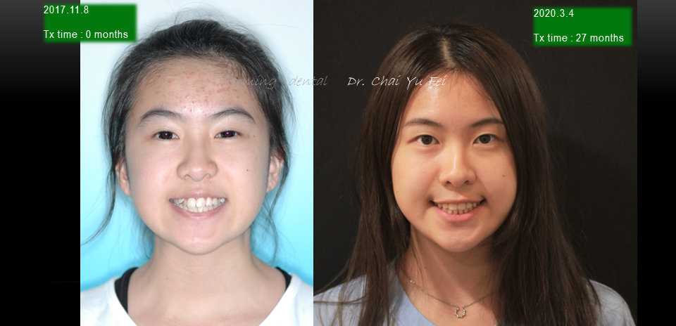 咬合不正矯正案例