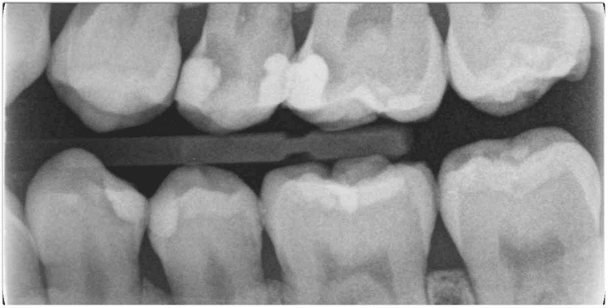 根管活髓保存術