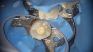 小朋友活髓治療