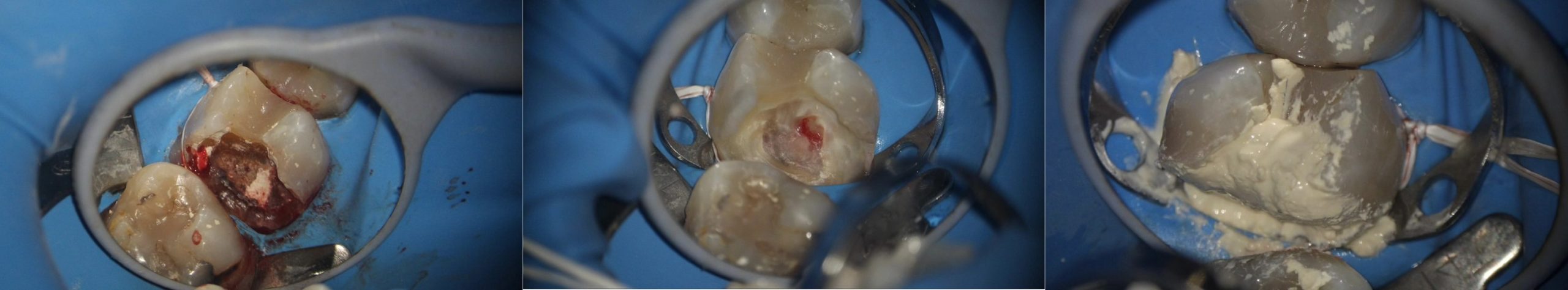 活髓治療合併全瓷假牙案例分享