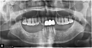 活動假牙全口重建