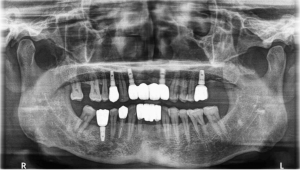 全口重建假牙崩壞案例