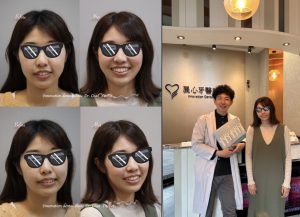 【台日跨國隱形矯正案例分享】成功克服地區與疫情限制-日本患者Ｓ小姐