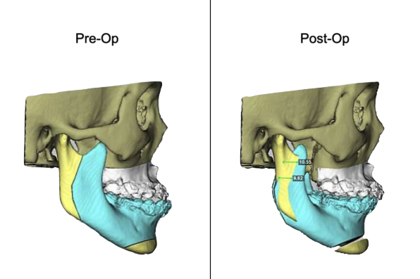 正顎手術合併矯正術前術後比對